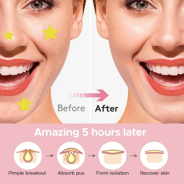 600PCS/Set Star Pimple Patch Acne Colorful Invisible Acne Removal Skin Care Stickers Concealer Face Spot Beauty Makeup Tools - Image 2